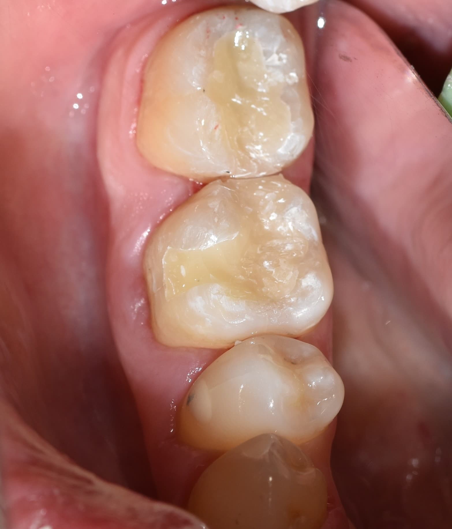 Caries