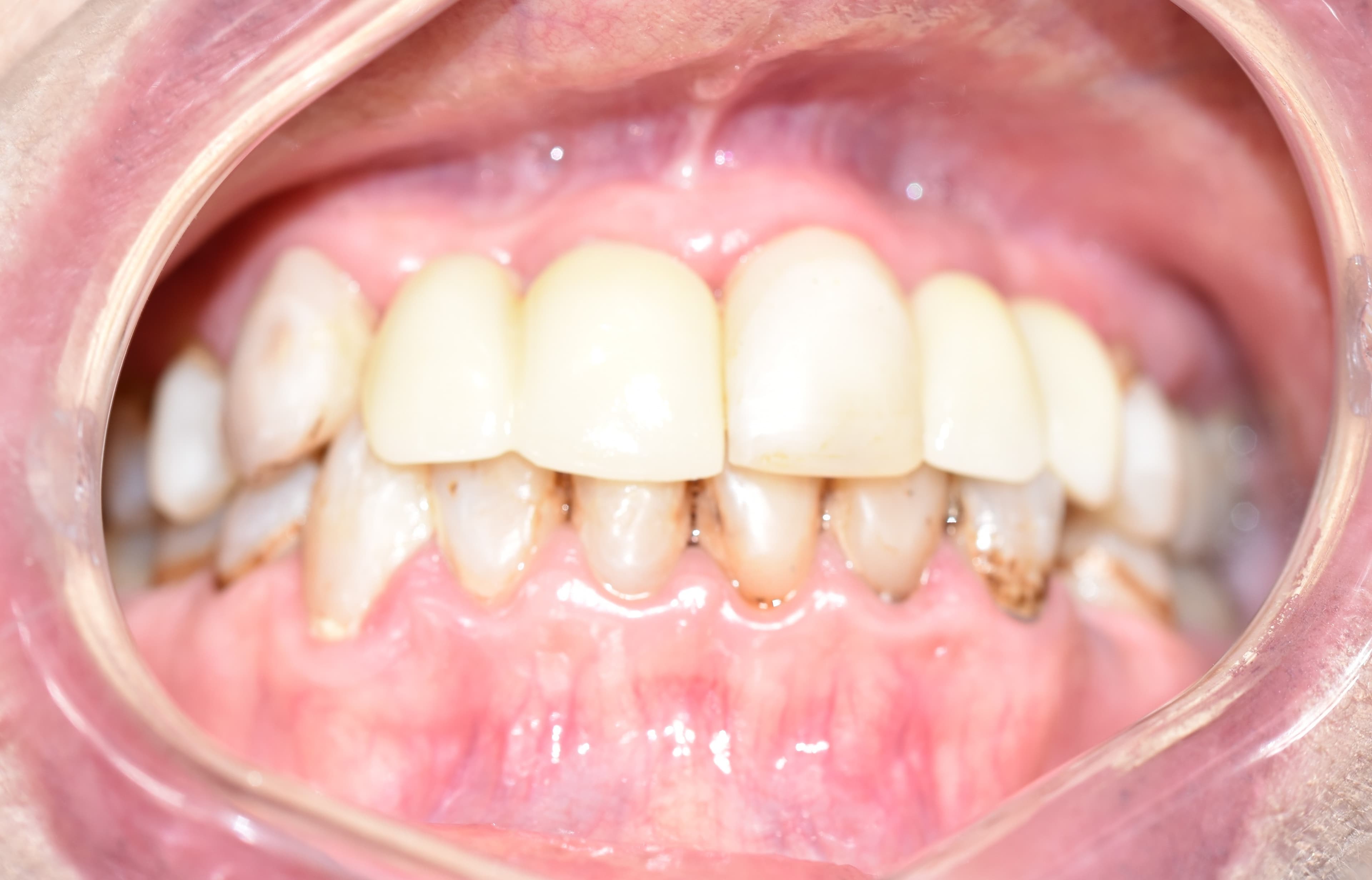 Dental Implants